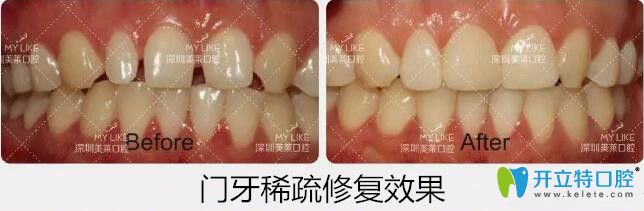 深圳美萊口腔牙齒稀疏貼面案例