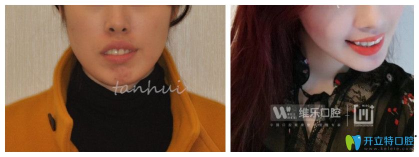 在維樂口腔驕橫突嘴齙牙案例