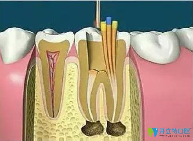 對根管進行填充封閉整個根管系統(tǒng) 對根管進行填充封閉整個根管系統(tǒng)