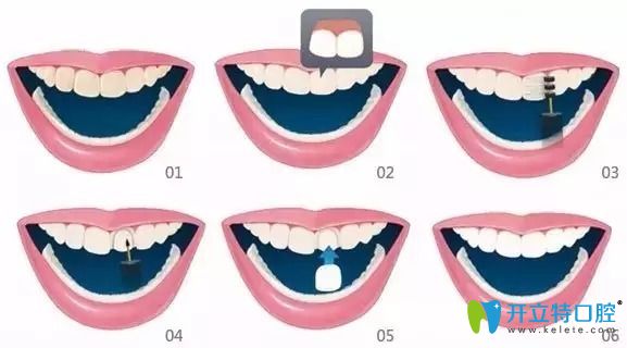 備受追捧的牙齒貼面材料選全瓷、硬質和樹脂貼面哪個好