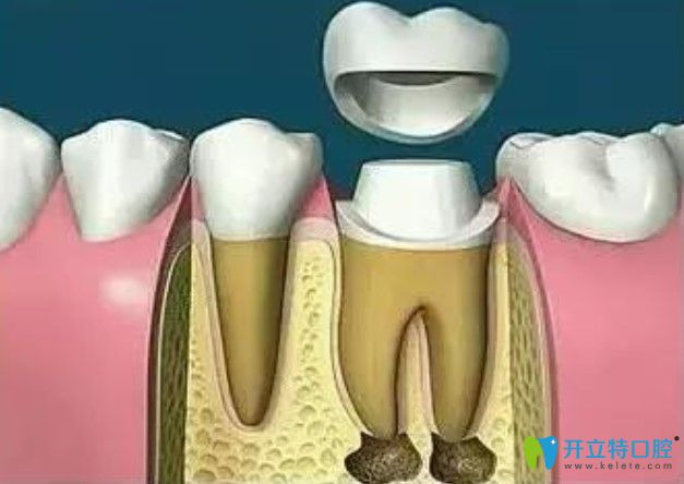 帶上牙冠保護壞牙完成修復(fù) 帶上牙冠保護壞牙完成修復(fù)