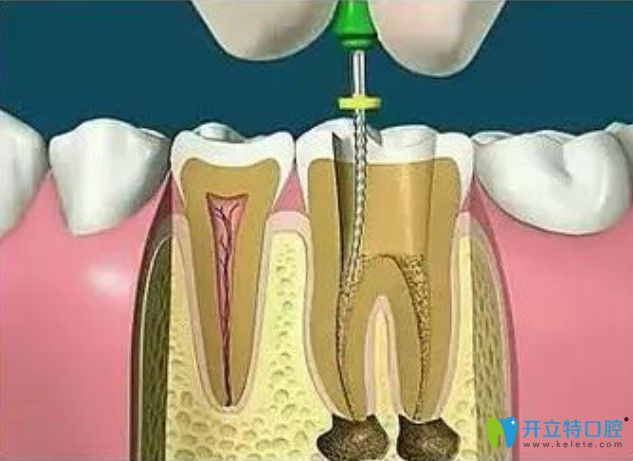 去除根管壁上的感染物 去除根管壁上的感染物