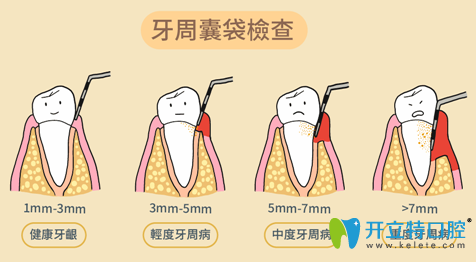 牙周袋深度檢查圖片