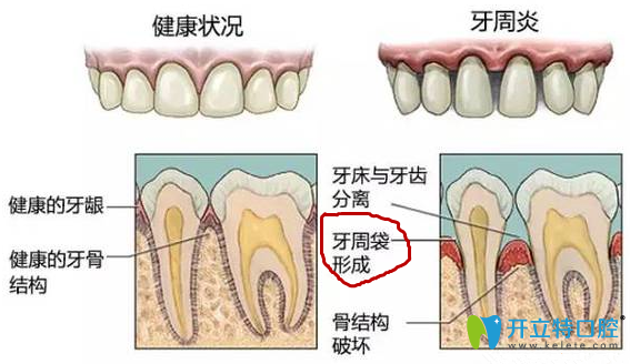 牙周袋怎么治療?收下這份深度三級分類療法大全及圖片