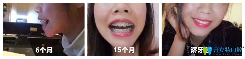 牙齒矯正3個(gè)月-下牙套變化圖 