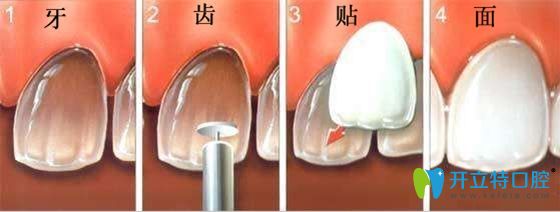 還在糾結美加牙貼面和義獲嘉瓷貼面選哪個好嗎?答案來了!