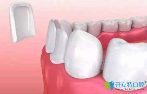 牙齒貼面有后遺癥？千萬別做樹脂牙齒貼面的真相