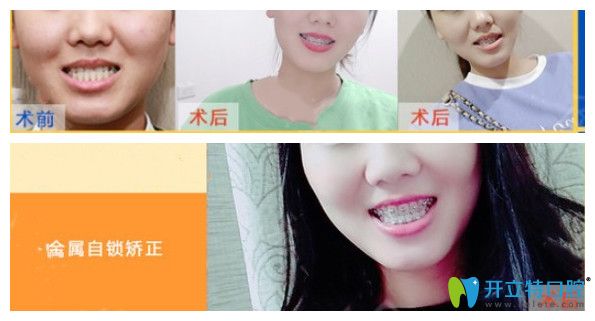 地包天MM在亞韓矯正牙齒后收獲愛情 地包天MM在亞韓矯正牙齒后收獲愛情