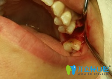 拔爛牙根過程及圖片了解一下疼嗎？關(guān)心多少錢可能會…