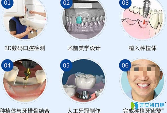 正夫口腔種植牙過程 正夫口腔種植牙過程