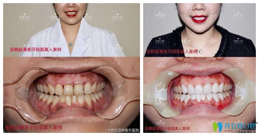 亞韓口腔黃牙做了超薄牙貼面修復(fù)案例對比圖 亞韓口腔黃牙做了超薄牙貼面修復(fù)案例對比圖