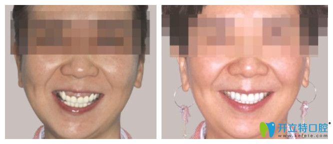 王女士牙齒修復(fù)完的效果