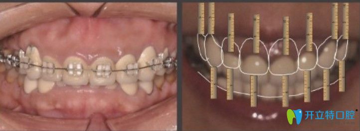 王女士牙齒矯正+修復(fù)過程圖示