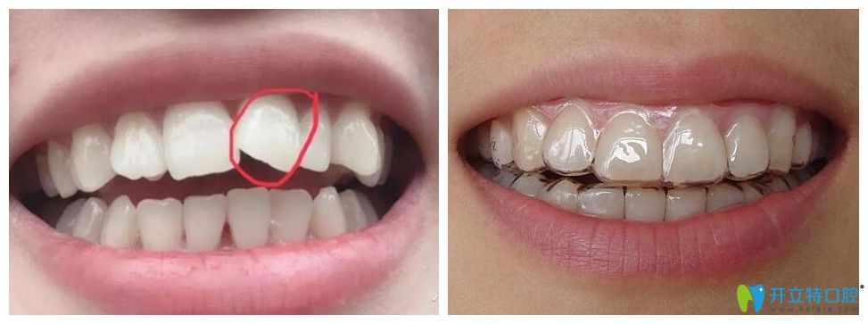 隱秀隱形矯正案例效果圖