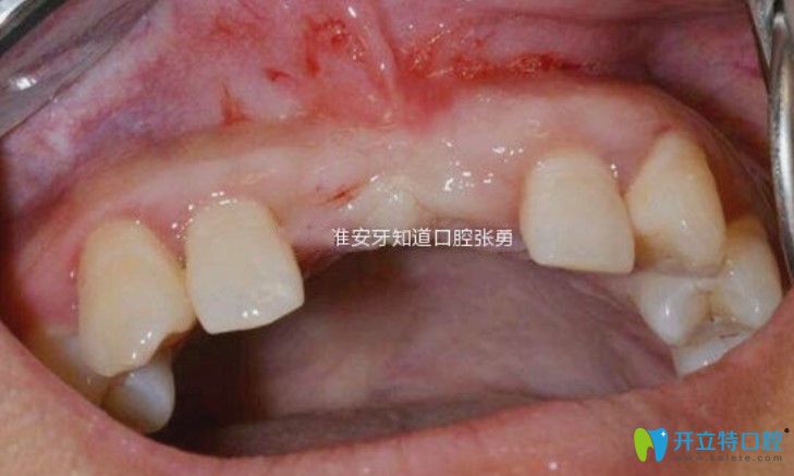 淮安哪里做種植牙好？顧客反饋淮安牙知道張勇種牙水平高