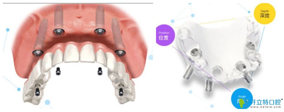 美奧口腔3d數(shù)字化種植牙