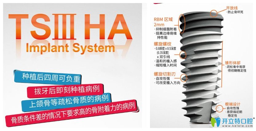 TSⅢ HA也是奧齒泰TS系中的一種