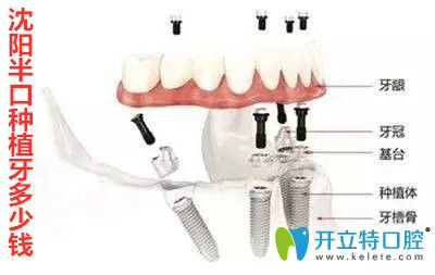沈陽半口種植牙多少錢