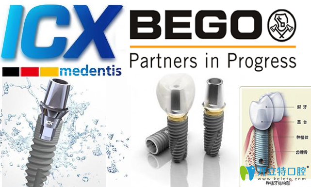 德國icx和德國bego種植系統(tǒng)