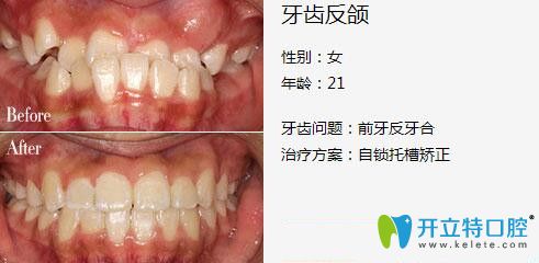 深圳弘和口腔地包天矯正案例