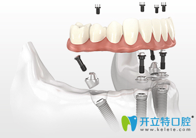 allon4半口種植牙