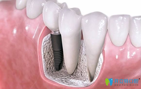 種植體在牙槽骨內(nèi)的展示圖