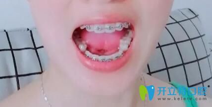 我在靖江艾齒嘉口腔戴牙套3個(gè)月 我在靖江艾齒嘉口腔戴牙套3個(gè)月