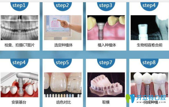 不翻瓣微創(chuàng)種植牙要不要縫線,需要多久？多少錢？補牙必看