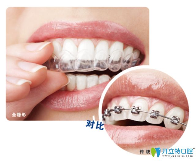 靖江艾齒嘉口腔朱彩寅醫(yī)生科普牙齒矯正注意事項 靖江艾齒嘉口腔朱彩寅醫(yī)生科普牙齒矯正注意事項