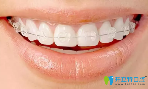 半隱形牙齒矯正明顯嗎？得從隱形和半隱形矯正的區(qū)別說起