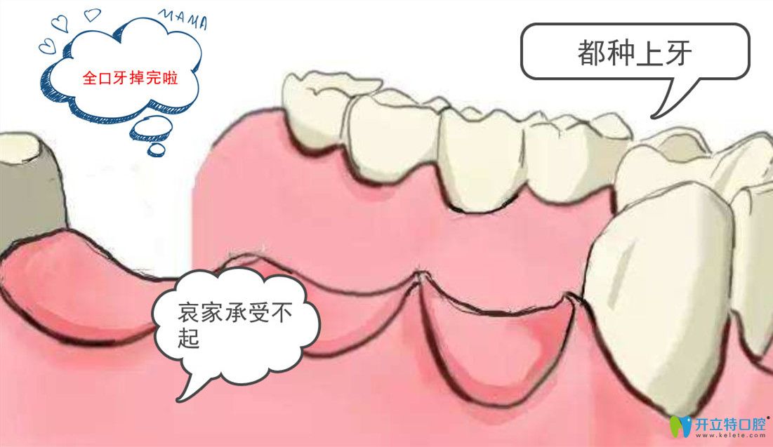 種植全口牙需要種幾顆？諾貝爾全口種植牙8顆多少錢?