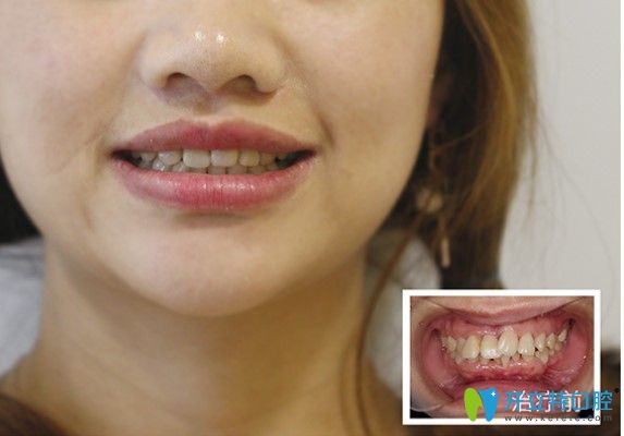 牙齒矯正有辣么厲害嗎？歪牙小姐姐通過正畸重獲整齊牙齒