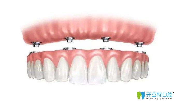 種植全口牙需要種幾顆