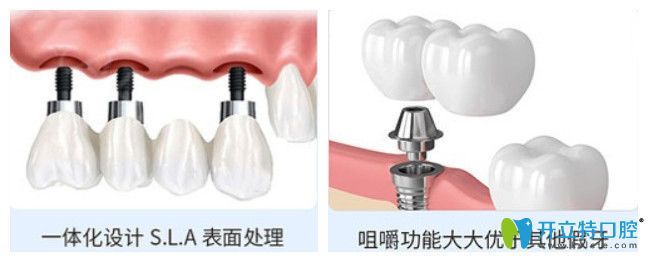 正夫口腔進(jìn)口種植體的優(yōu)勢(shì)