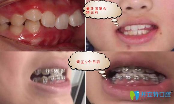 更新上海永華口腔仇玲牙齒矯正案例近期效果,親們速來查看