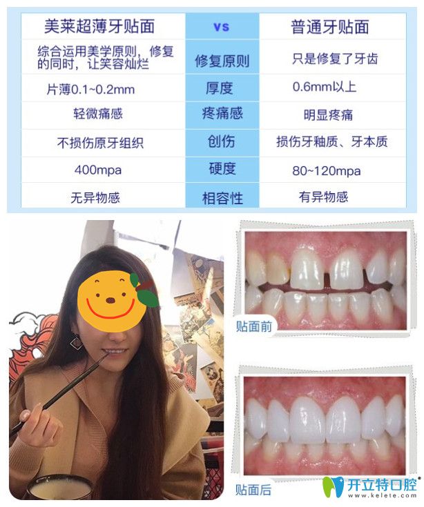 美萊超薄牙貼面你無悔的選擇，小姐姐來曬牙貼面后對比照