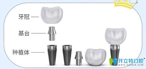 缺牙為什么要選擇進(jìn)口種植體