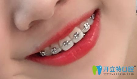 在深圳佳美口腔矯正牙齒一年的效果圖