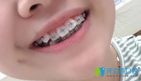 我戴金屬自鎖牙套矯正4個(gè)月效果圖