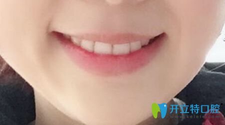 我戴金屬自鎖托槽矯正牙齒后的效果