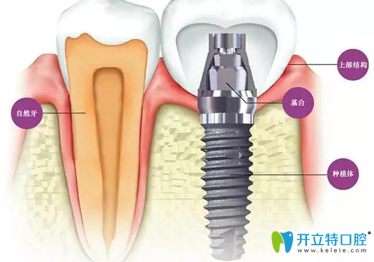 牙槽骨小于幾毫米不能種牙？怎么判斷牙槽骨薄,這篇就夠了