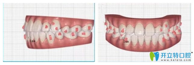 戴4個(gè)月隱適美牙套牙齒的情況