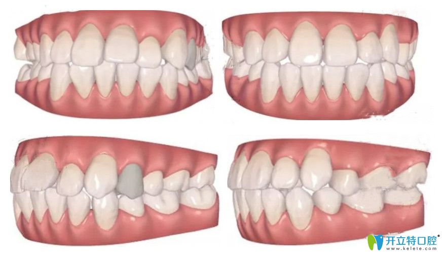 公開我的隱適美矯正齙牙記錄！我?guī)а捞?~12月變化圖明顯不