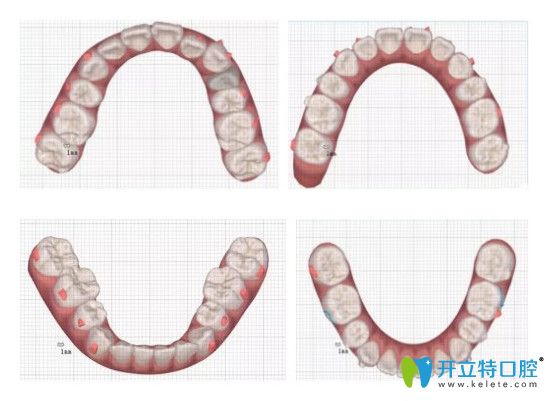 帶隱適美牙套矯正齙牙12個(gè)月前后對(duì)比圖