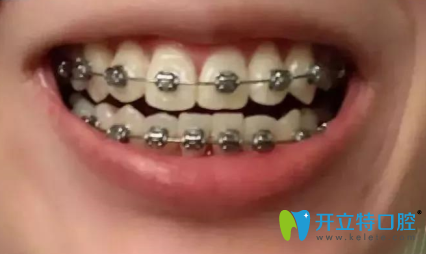 我虎牙外突側(cè)門牙扭轉(zhuǎn)，矯正兩年后的效果