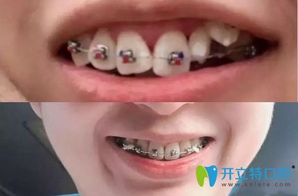 誰說扭轉(zhuǎn)牙很難矯正,我在深圳美佳德口腔矯正兩年就改善了