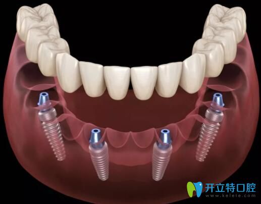 寧波恒美口腔allon4全口種植技術(shù)