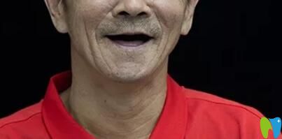 在寧波恒美口腔做種植牙前的照片