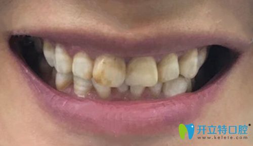 聽說做了瓷貼面感覺牙好假,我在寧波恒美口腔做的很自然呀