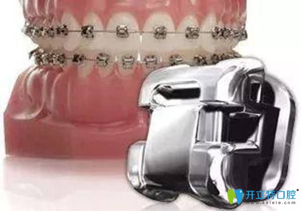 鋼牙和隱適美哪個(gè)效果好,探討鋼牙后悔換隱適美的原因